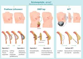 borst-reconstructie