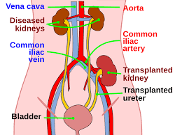 Hoop op een Nieuw Begin: Alles wat je moet weten over niertransplantatie