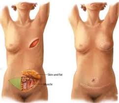 diep flap reconstructie ervaringen