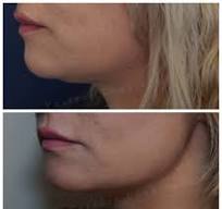 Een stralende kaaklijn met onze innovatieve HIFU behandelingen!