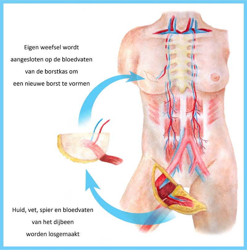 Herstel van Vrouwelijkheid: Borstreconstructie als Hoopvolle Stap naar Genezing