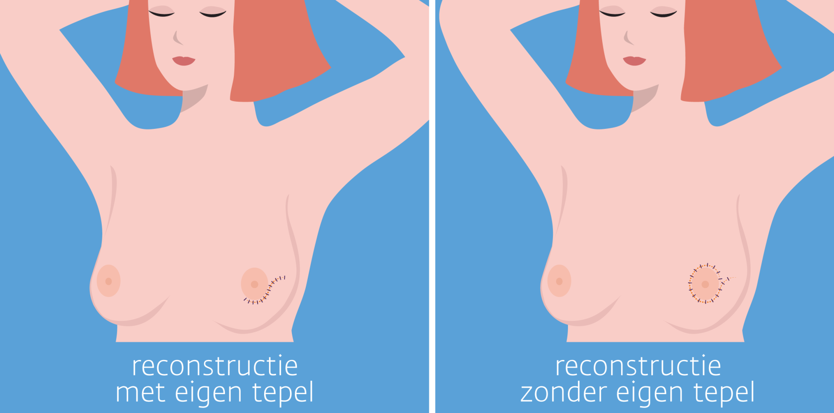 Herstel en Hoop: Reconstructie na Mamma Amputatie