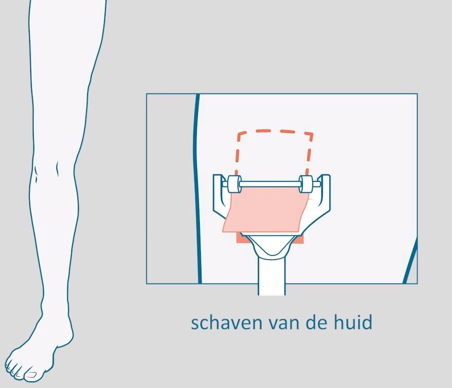 Huidtransplantatie: Innovatieve Oplossingen voor Huidproblemen