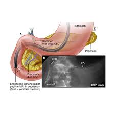 ercp medisch